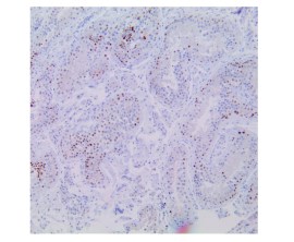 CD10 Clone 56C6 Pronto Para Uso - 6 Ml - Easypath - EP-12-50406